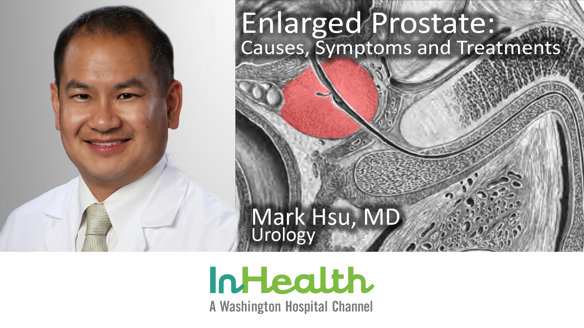 Enlarged Prostate Causes Symptoms And Treatment Washington Hospital Healthcare System 1060